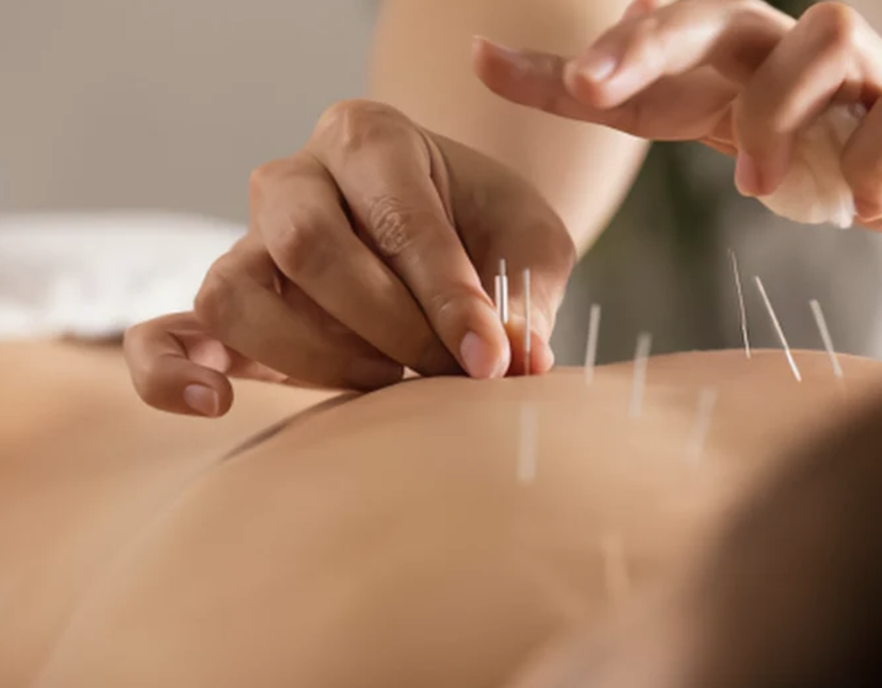 A therapist performing acupuncture.